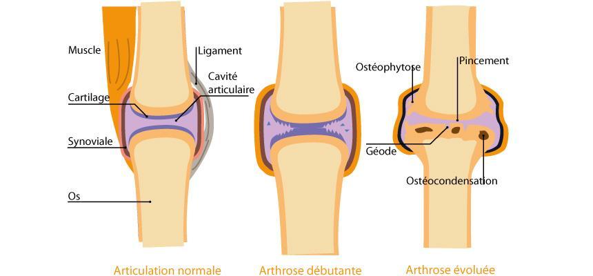 metode de tratament chirurgical al artrozei)