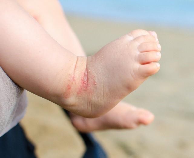 Plaque d'eczema sur pied nourisson